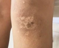 نتيجة علاج البهاق بجهاز الإكزيمر بعد الجلسات (علاج البهاق) — عيادة تجميل وجلدية بالشرقية مركز الماسة د. صفاء الجوهري