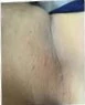نتيجة إزالة الزوائد الجلدية بالليزر بعد الجلسات (إزالة الزوائد الجلدية بالليزر) — عيادة تجميل وجلدية بالشرقية مركز الماسة د. صفاء الجوهري
