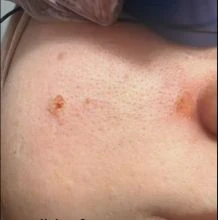 نتيجة إزالة حسنة بالليزر وتطهير البشرة بعد الجلسات (إزالة حسنة) — عيادة تجميل وجلدية بالشرقية مركز الماسة د. صفاء الجوهري