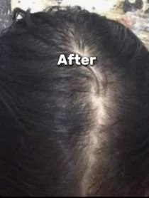 نتيجة البلازما والميزوثيرابي لعلاج تساقط الشعر بعد الجلسات (علاج تساقط الشعر) — عيادة تجميل وجلدية بالشرقية مركز الماسة د. صفاء الجوهري